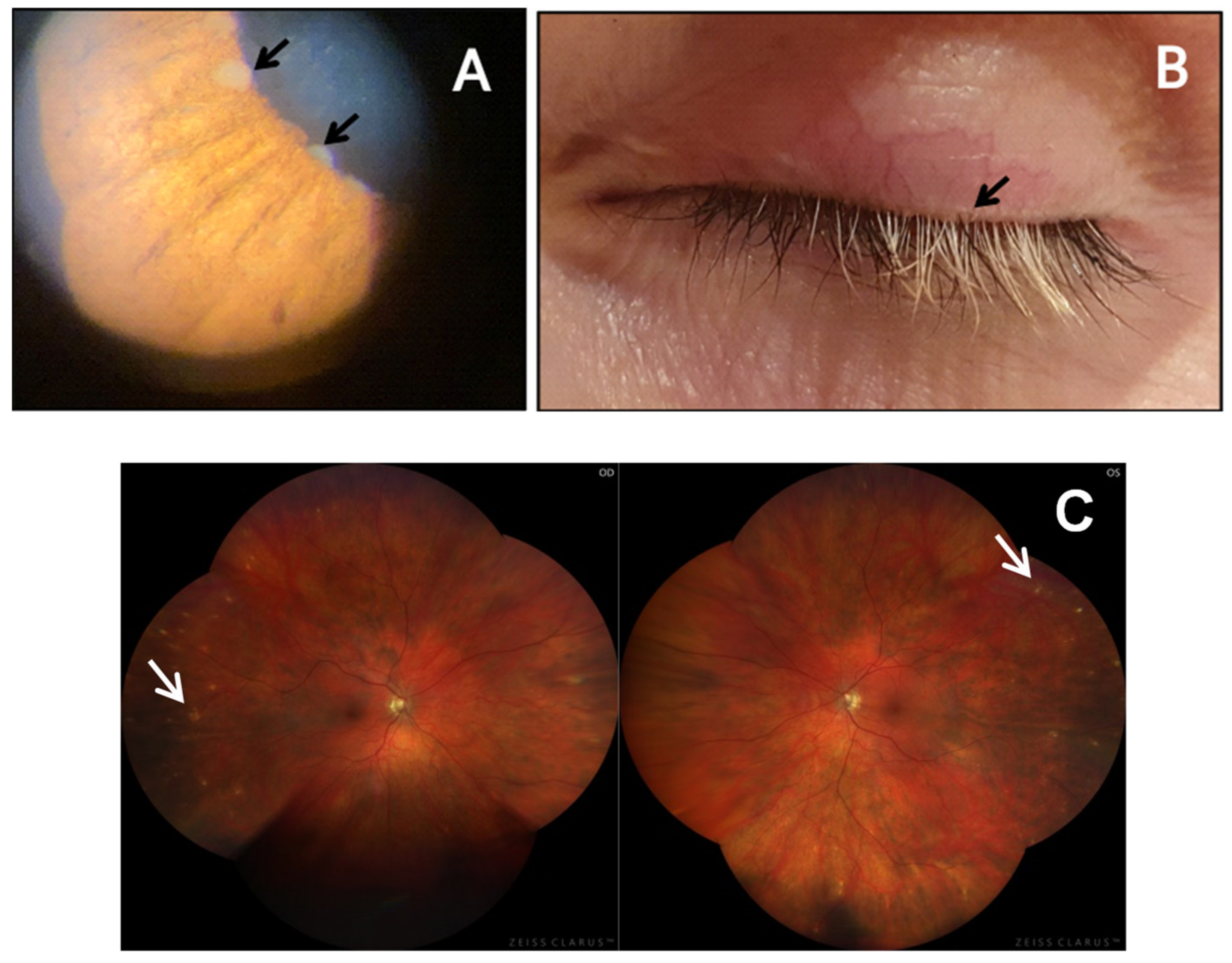 Cells | Free Full-Text | Vogt-Koyanagi-Harada Disease Exacerbation