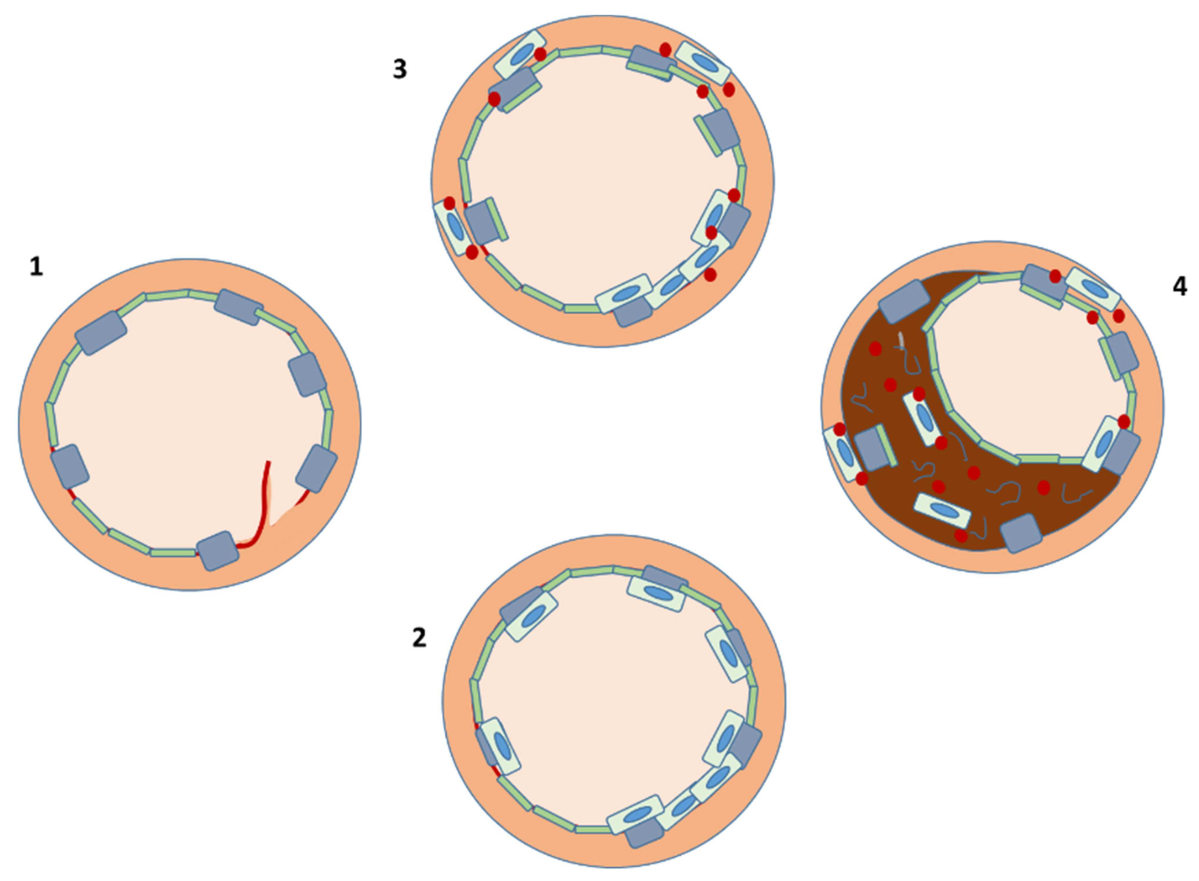 Cells | Free Full-Text | Restenosis after Coronary Stent Implantation:  Cellular Mechanisms and Potential of Endothelial Progenitor Cells (A Short  Guide for the Interventional Cardiologist)