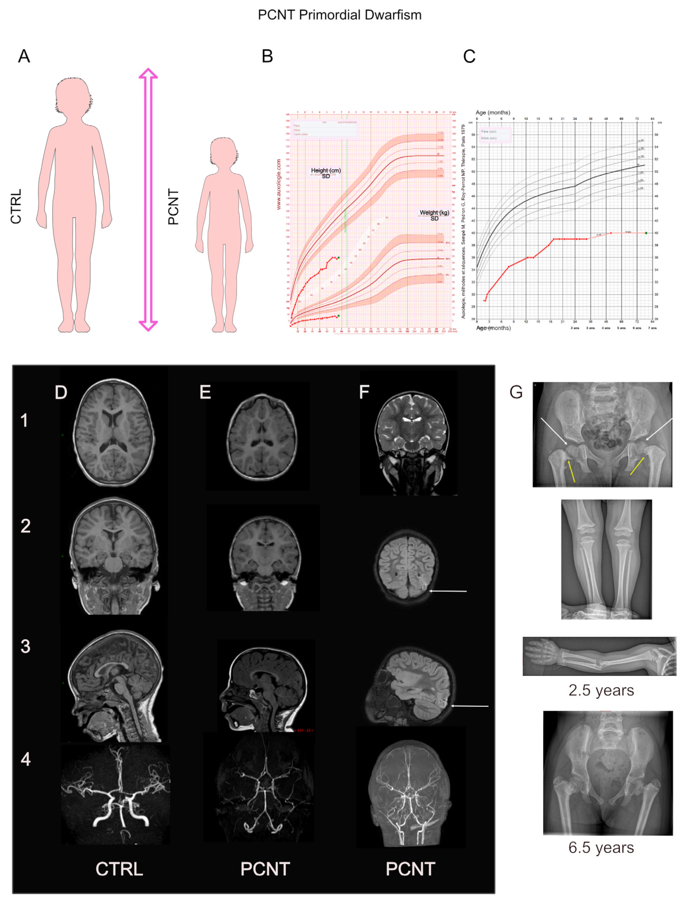 microcephalic osteodysplastic primordial dwarfism type ii
