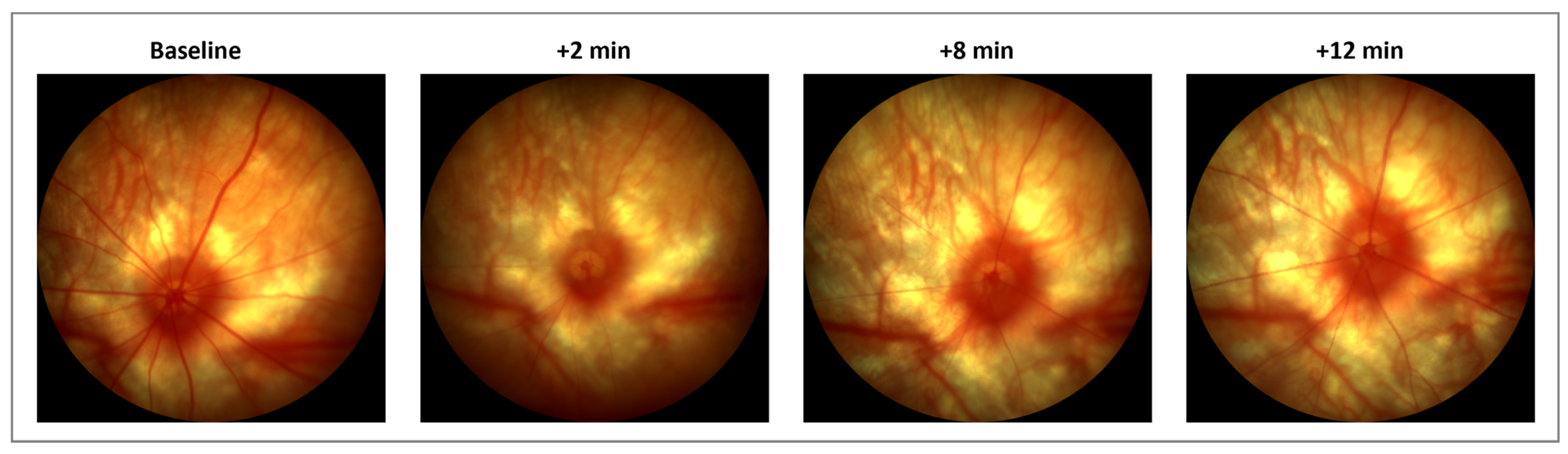 Cells Free Full Text Intraocular Adeno Associated Virus