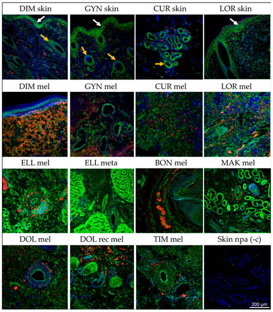 Cells | Free Full-Text | Deregulation of Metalloproteinase Expression ...