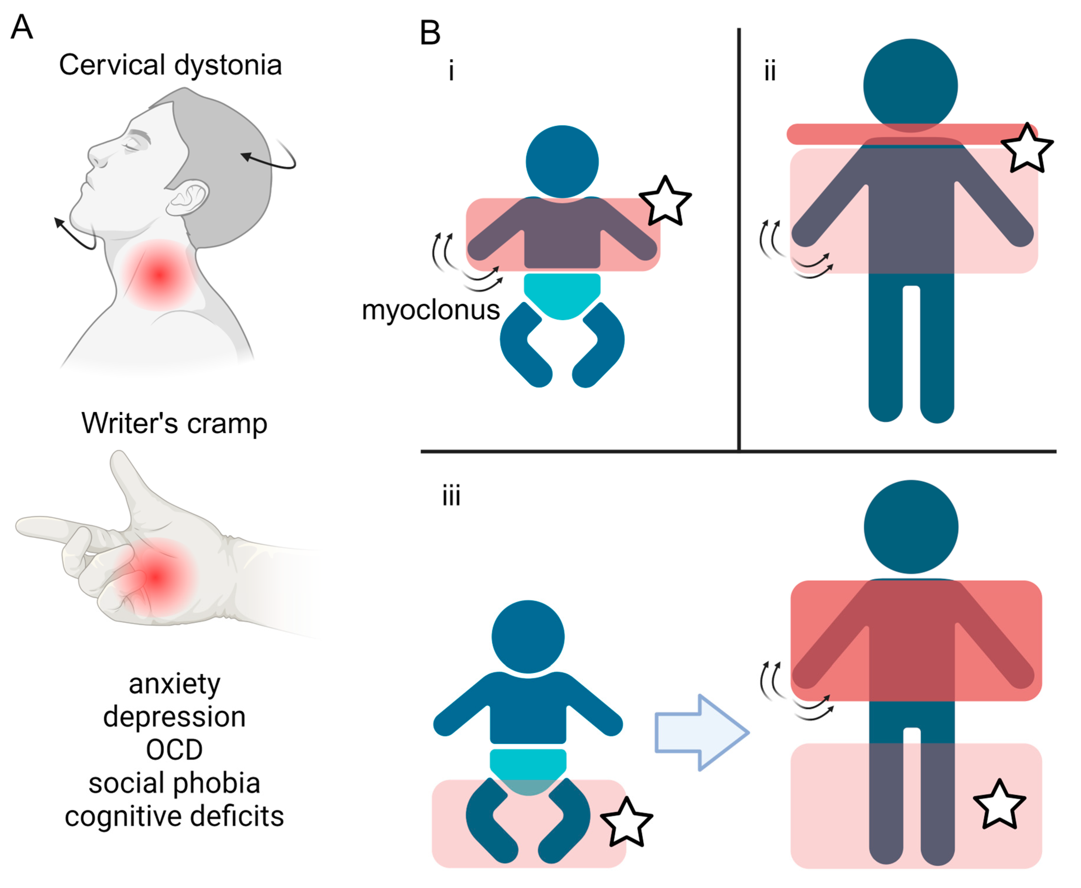 Deciphering the Pathophysiological Mechanisms Underpinning Myoclonus  Dystonia Using Pluripotent Stem Cell-Derived Cellular Models