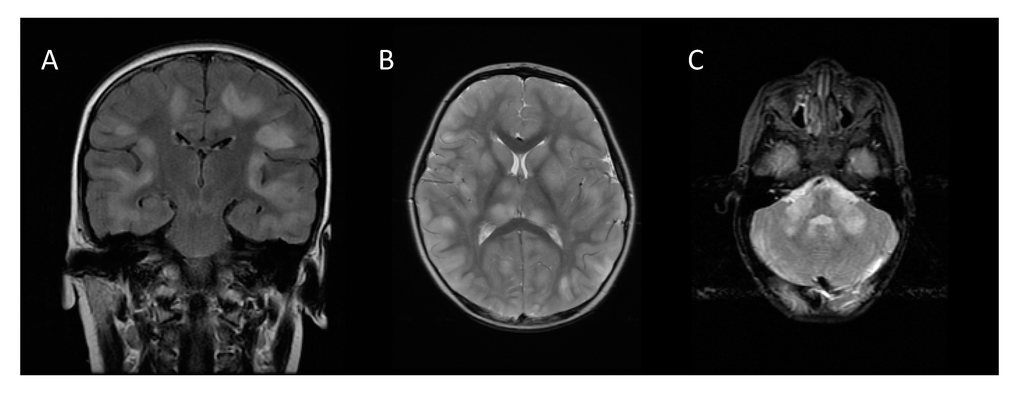 Children | Free Full-Text | Acute Disseminated Encephalomyelitis ...