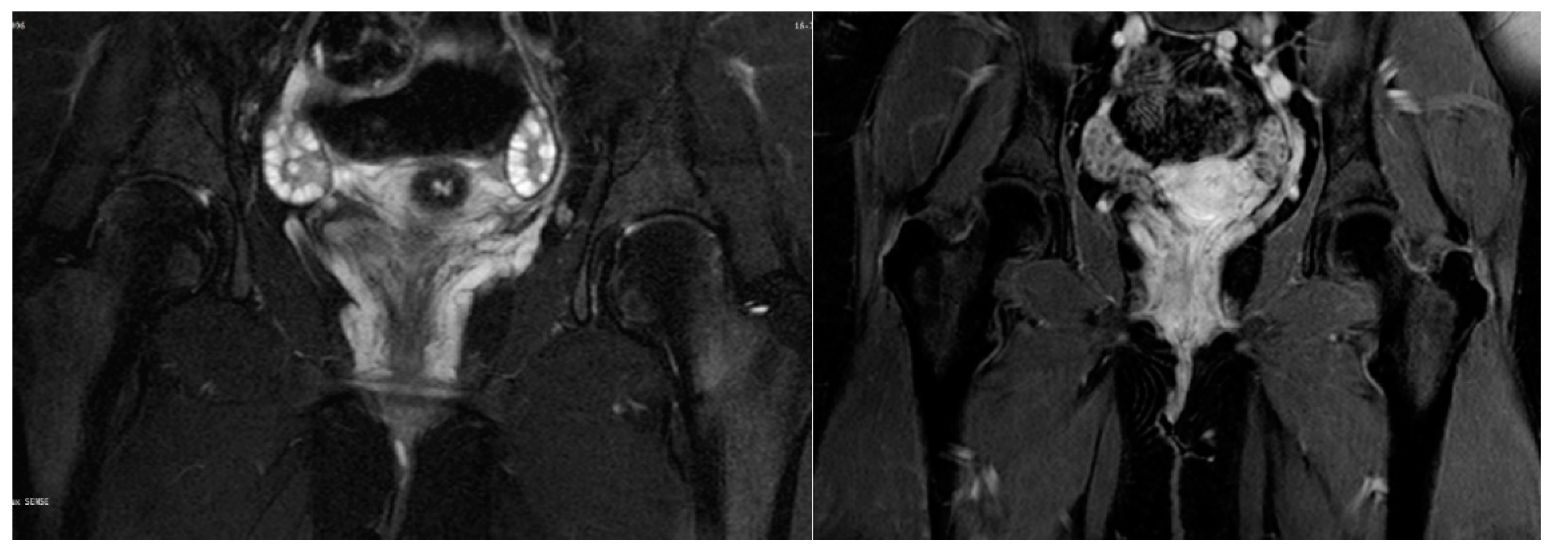 Bilateral Massive Hematoma of Bartholin Glands after Prolonged Labour: A  Case Report