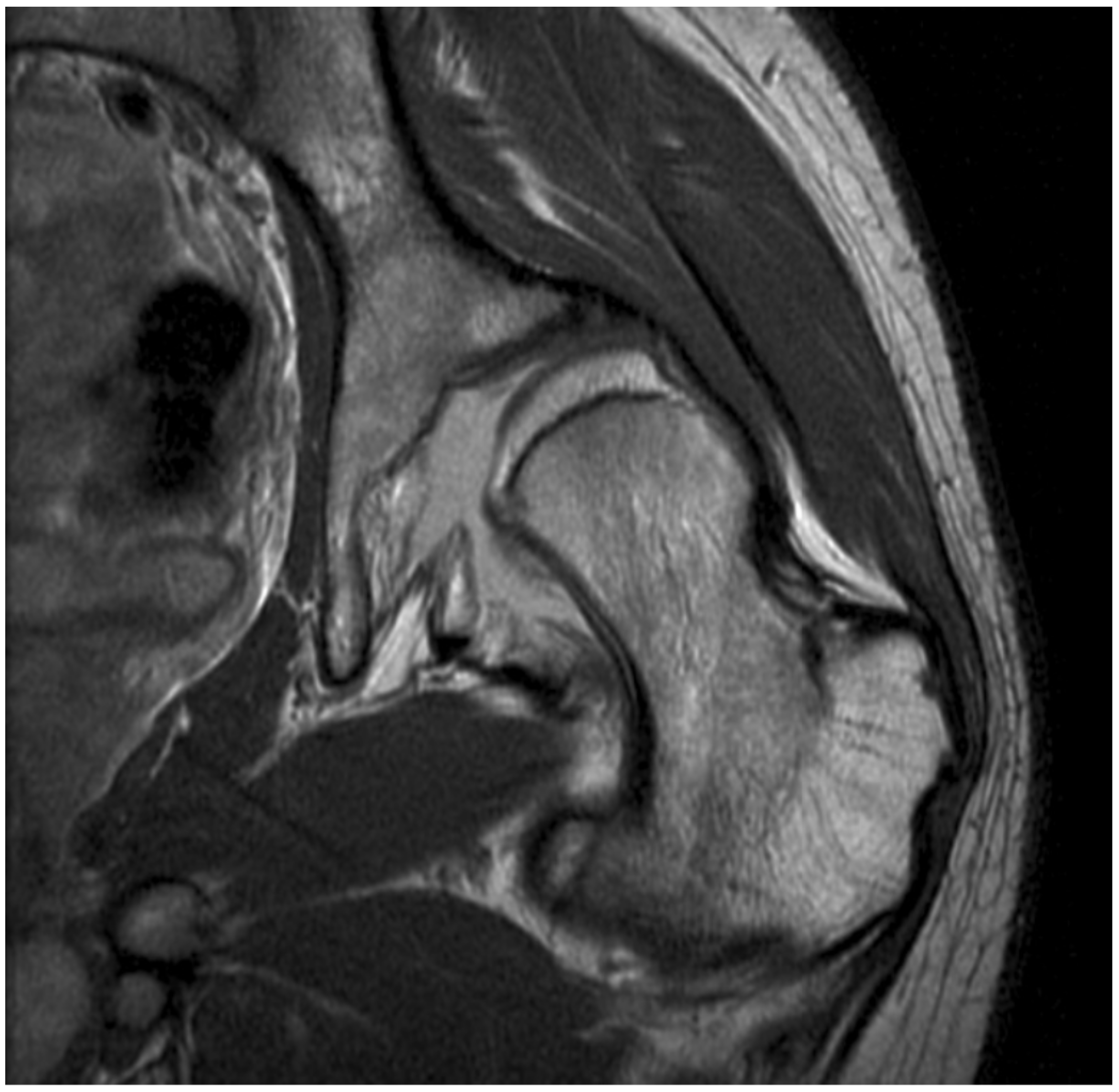 Children | Free Full-Text | Musculoskeletal Pathology in Cerebral Palsy