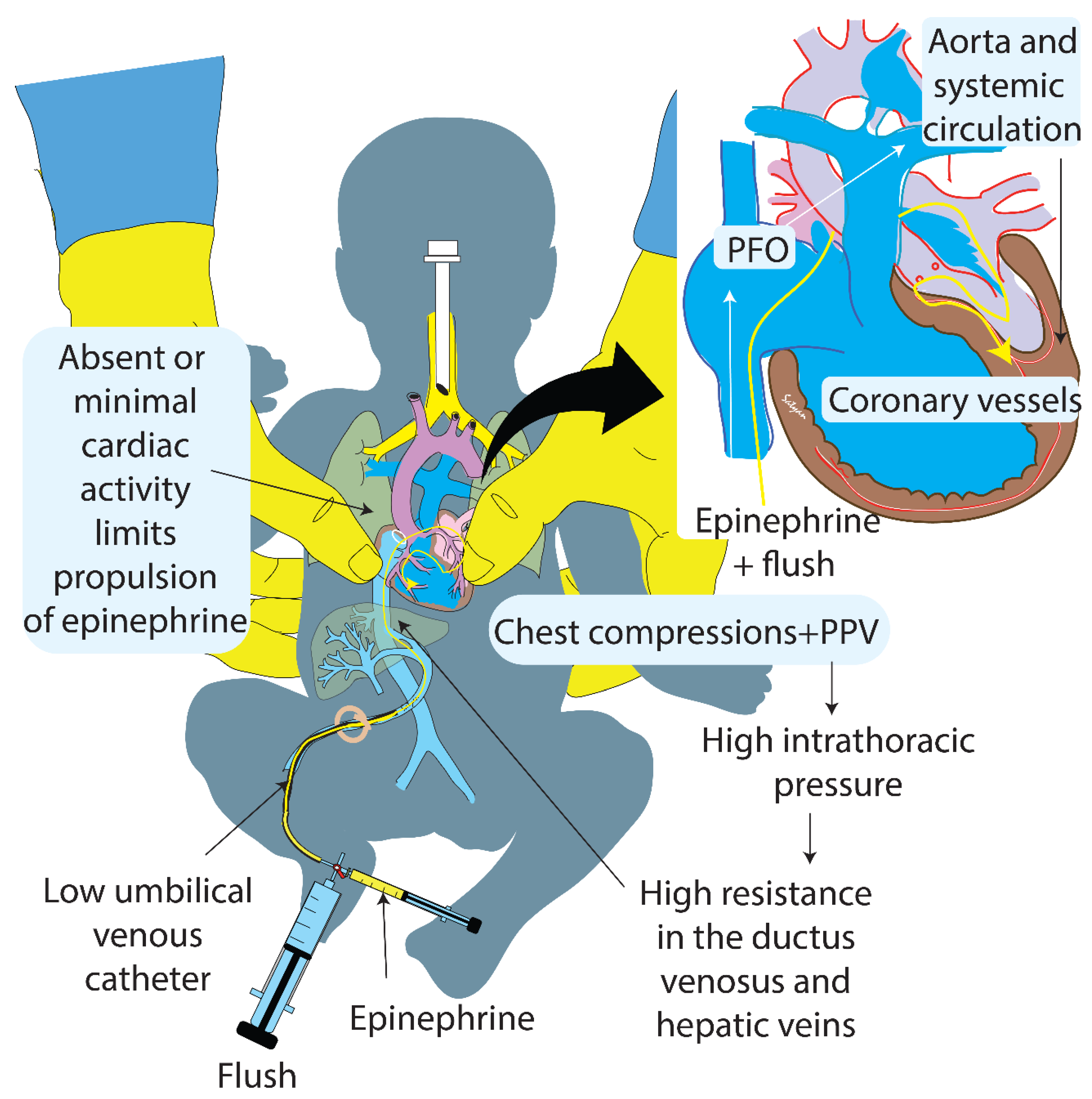 Neonatal Resuscitation (Part-4), 2020 AAP Guidelines