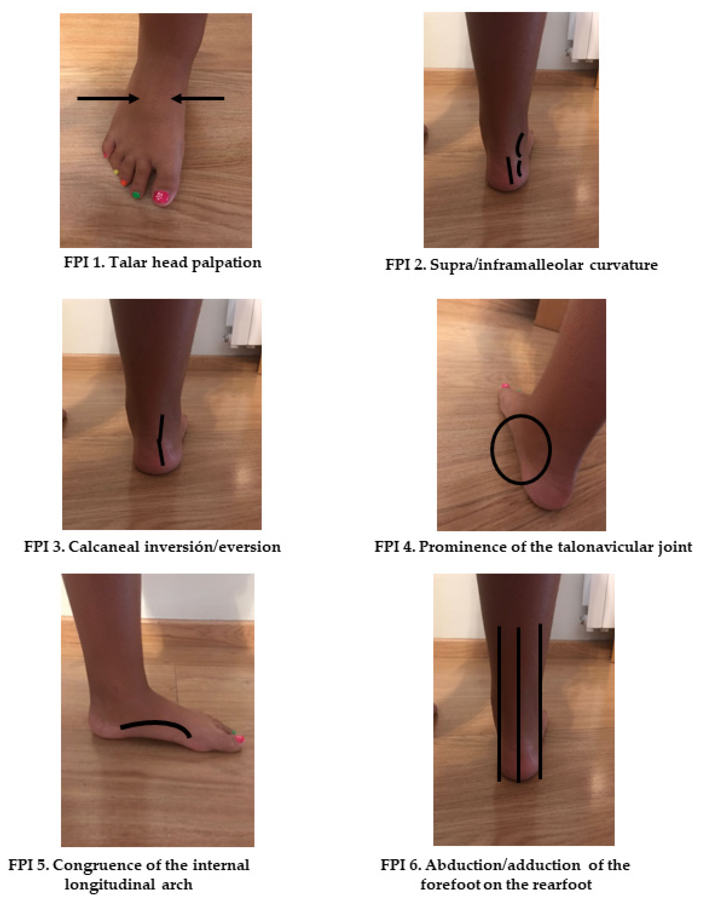 Children | Free Full-Text | Association between the Use of Backpack and  Static Foot Posture in Schoolchildren with Static Pronated Foot Posture: A  36-Month Cohort Study