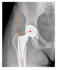 Children | Free Full-Text | Cementless Ceramic-on-Ceramic Total Hip  Replacement in Children and Adolescents
