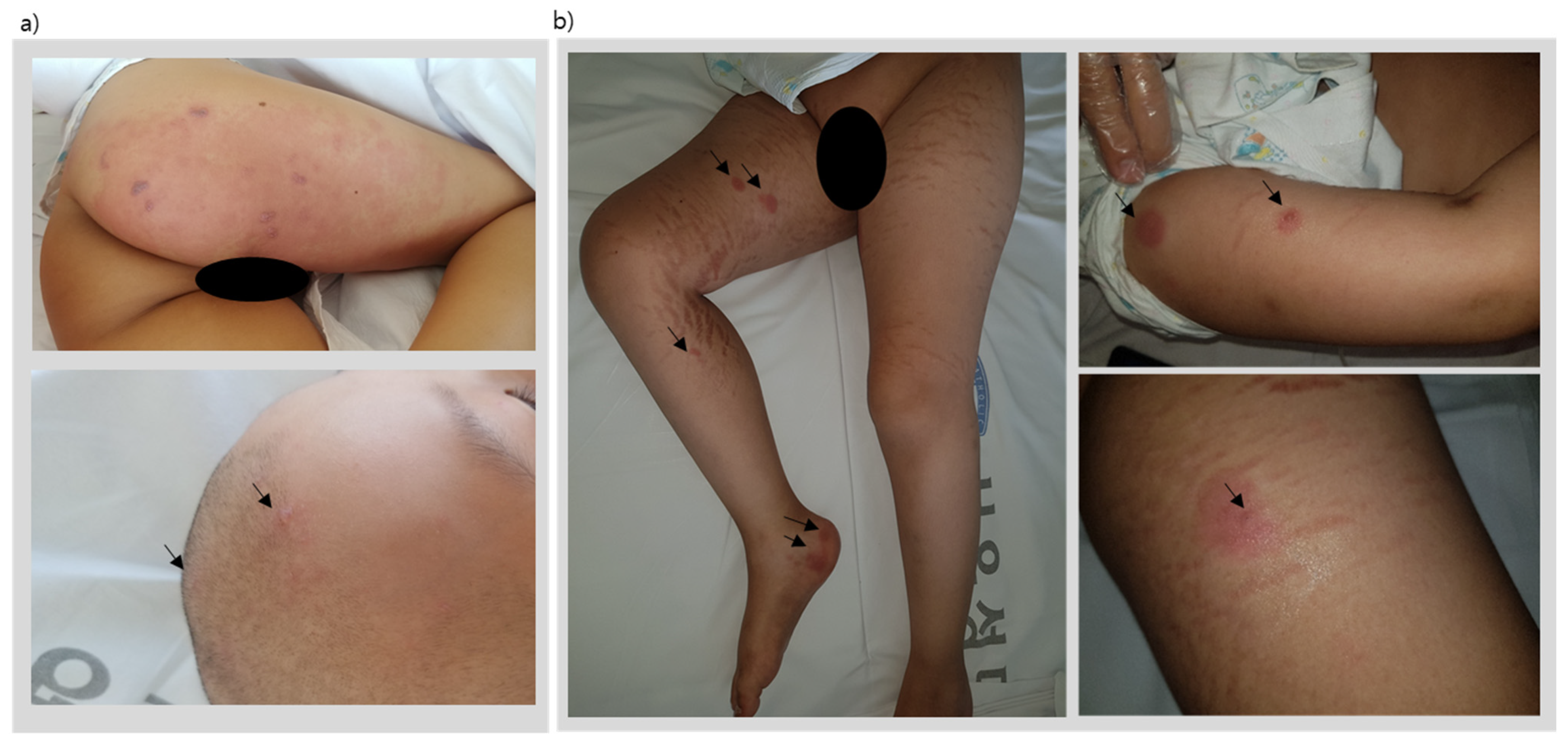 Children | Free Full-Text | A Case of Disseminated Herpes Zoster Presenting  as Vesicles Limited to Skin Lesions with Lymphoma Cutis Involvement
