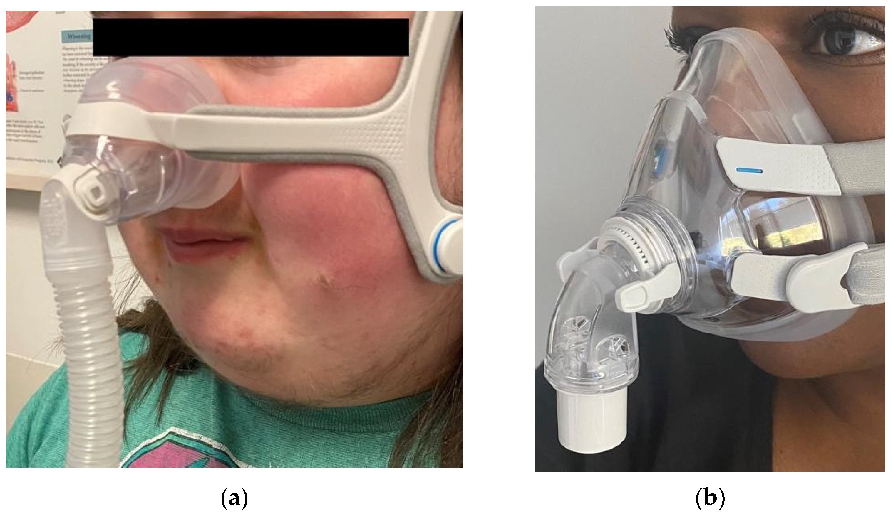 Children | Free Full-Text | Positive Airway Pressure Therapy for Pediatric  Obstructive Sleep Apnea