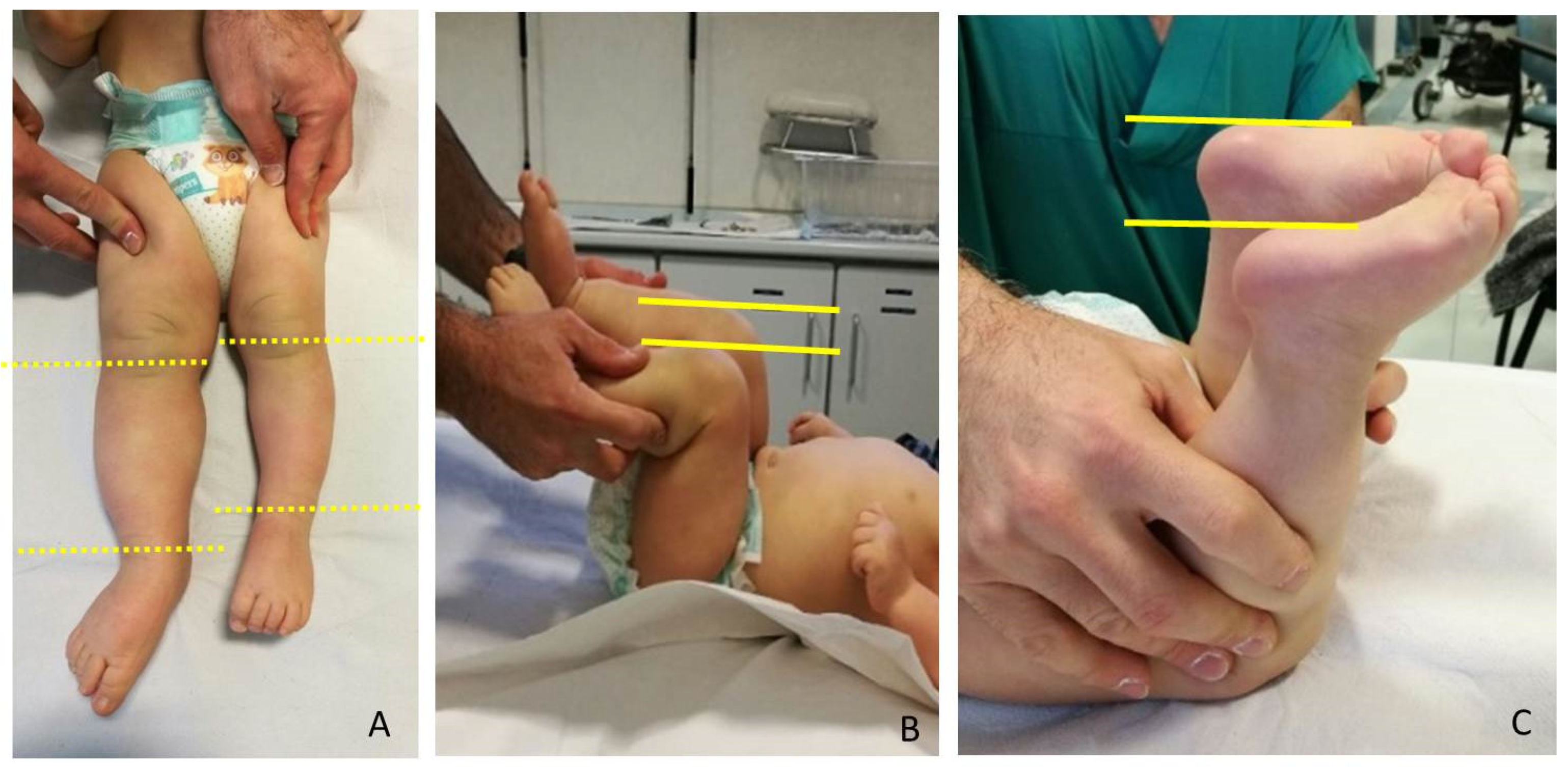 Children | Free Full-Text | Guided Growth in Leg Length Discrepancy in  Beckwith-Wiedemann Syndrome: A Consecutive Case Series