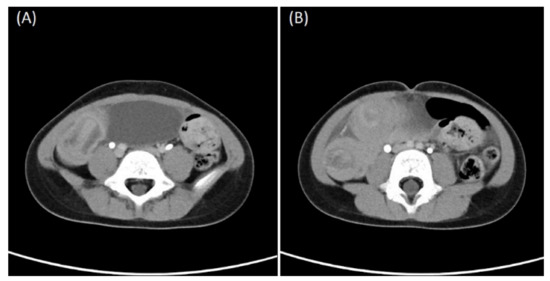 Teenager with right flank pain, Pediatric Radiology Case, Pediatric  Imaging