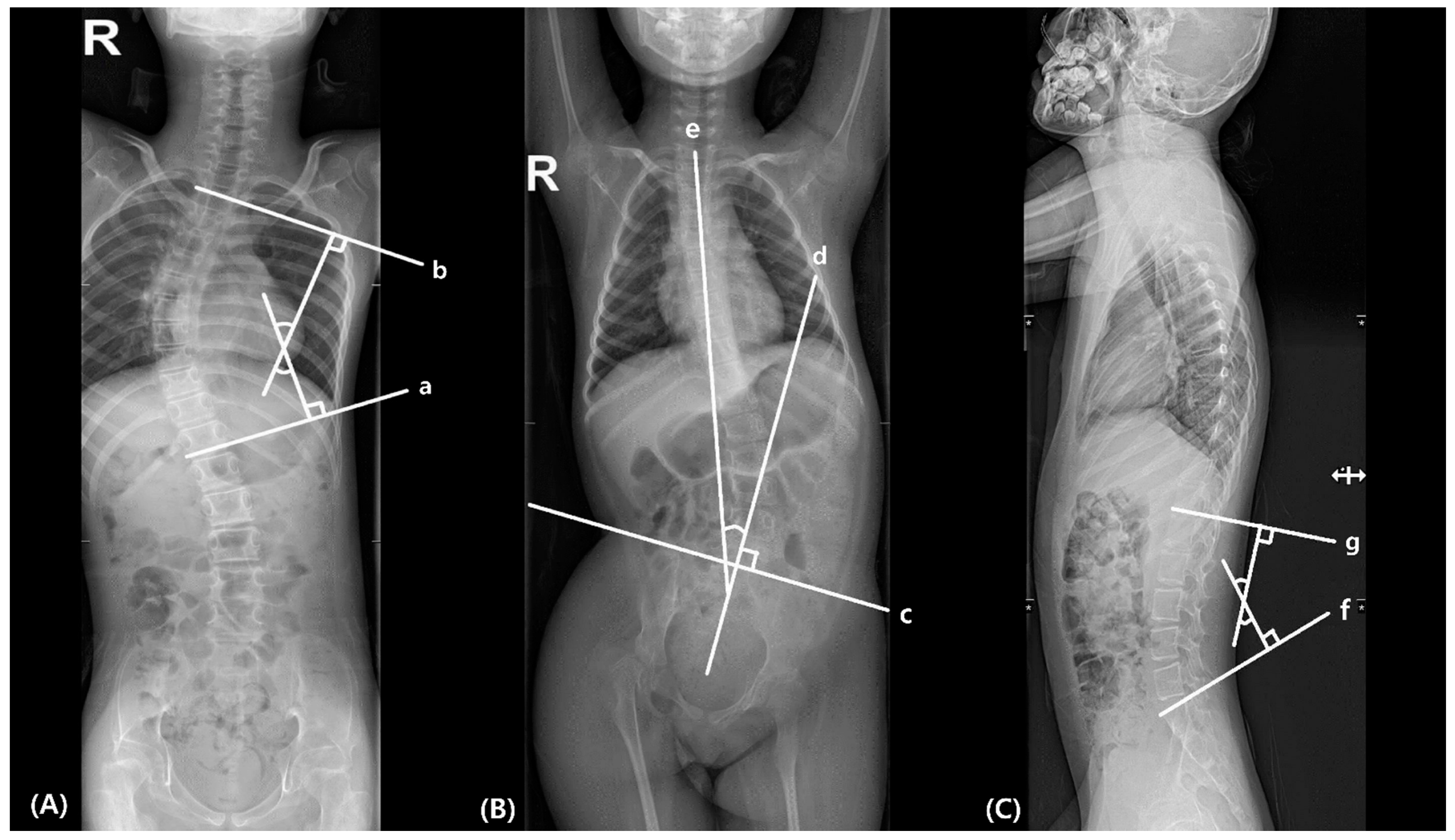 Scoliosis - Seating Matters