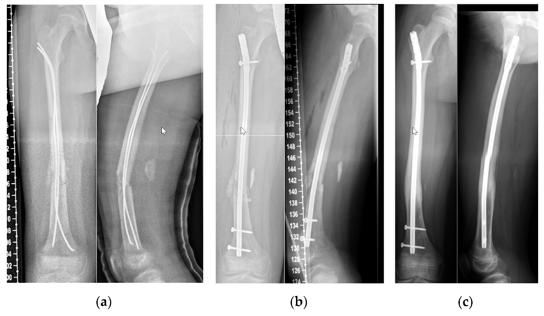 Multi-Fix Femoral Nail - Cannulated, Multi-Fix Femoral Nail - Cannulated  Manufacturer, Multi-Fix Femoral Nail - Cannulated Suppliers, Orthopedic  Implants, India