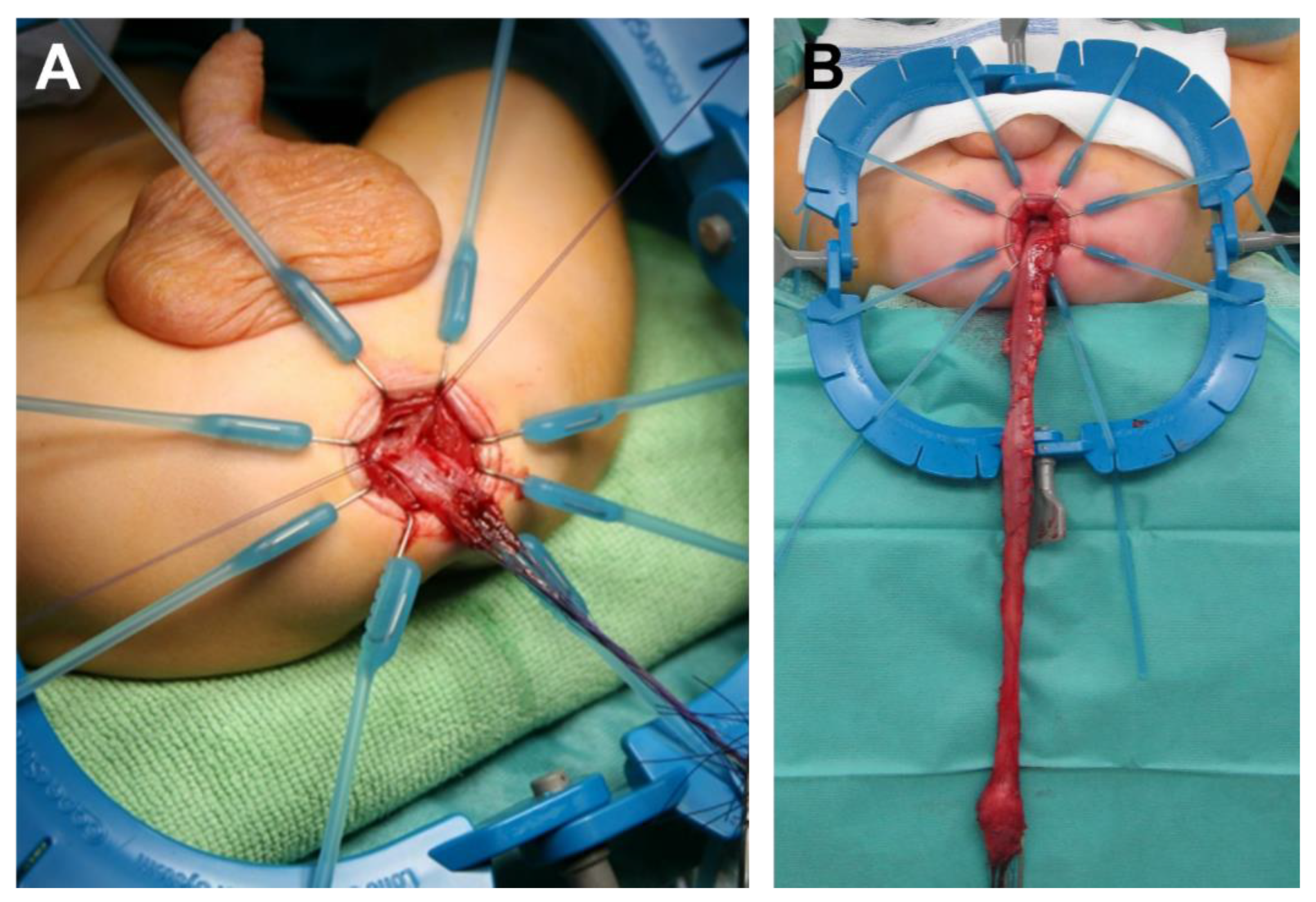 Case 52-1991 — An Eight-Year-Old Girl with Recurrent Abdominal Distention  after Surgical Correction of Hirschsprung's Disease