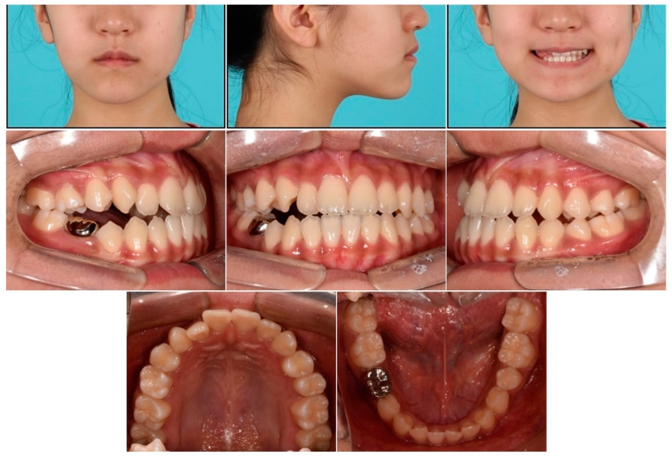 17-year-old female with Class II malocclusion and traumatic