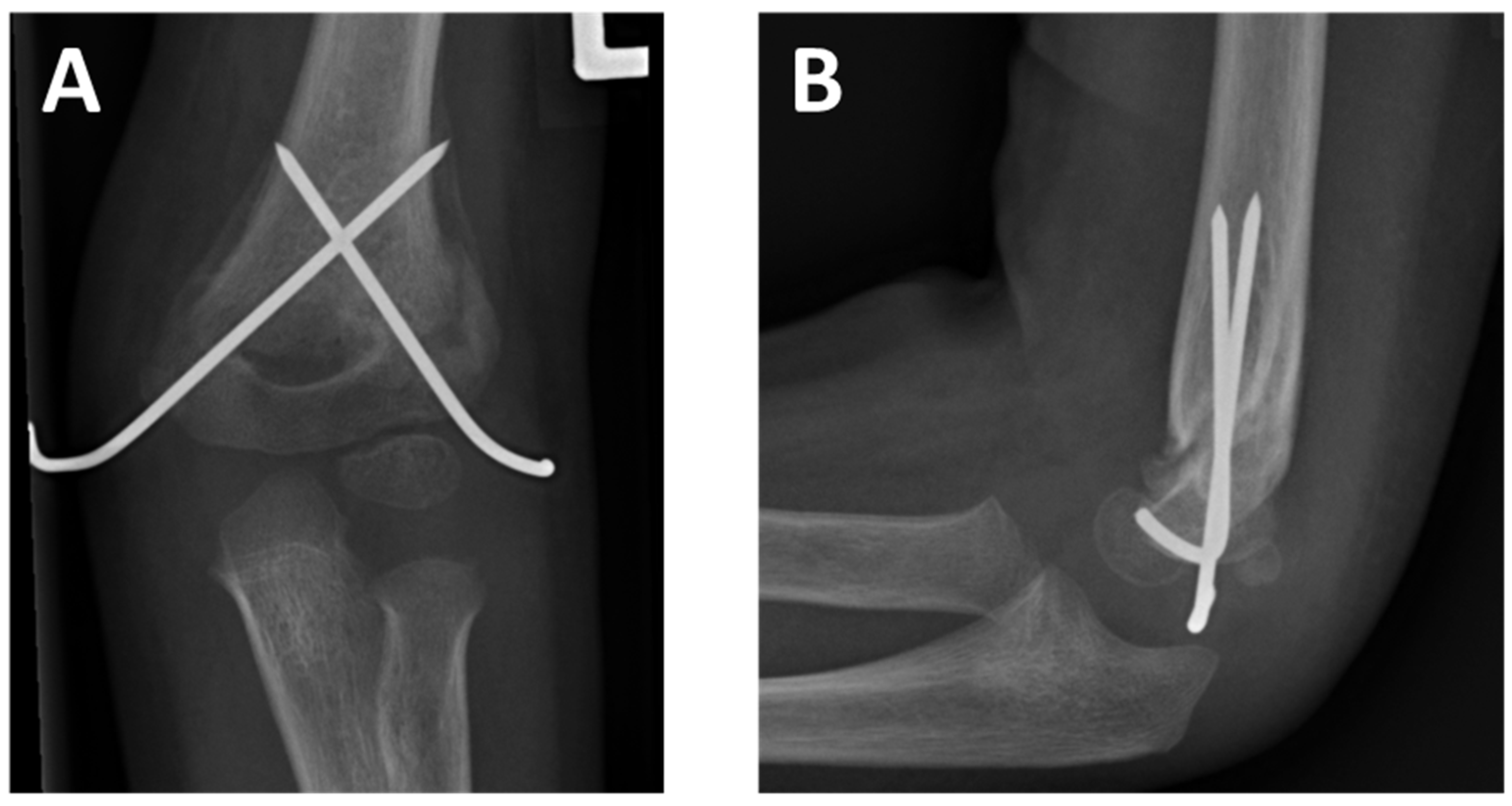 anderson silva broken leg x ray