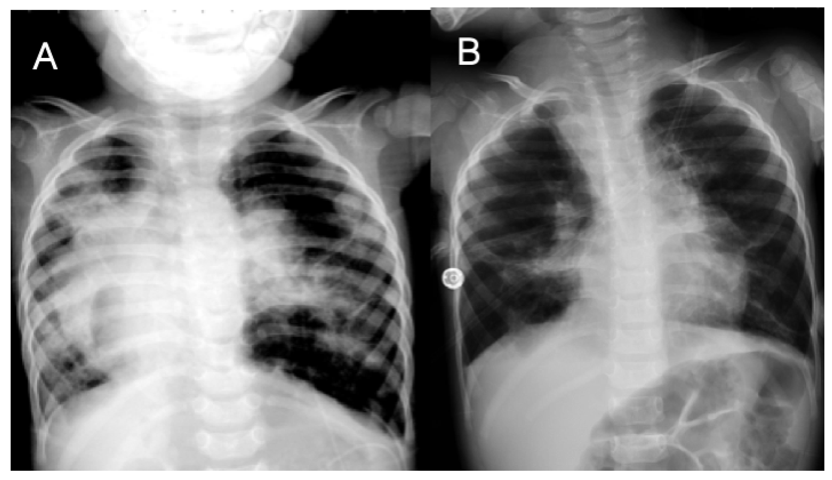 Pediatric Pulmonary Hypertension