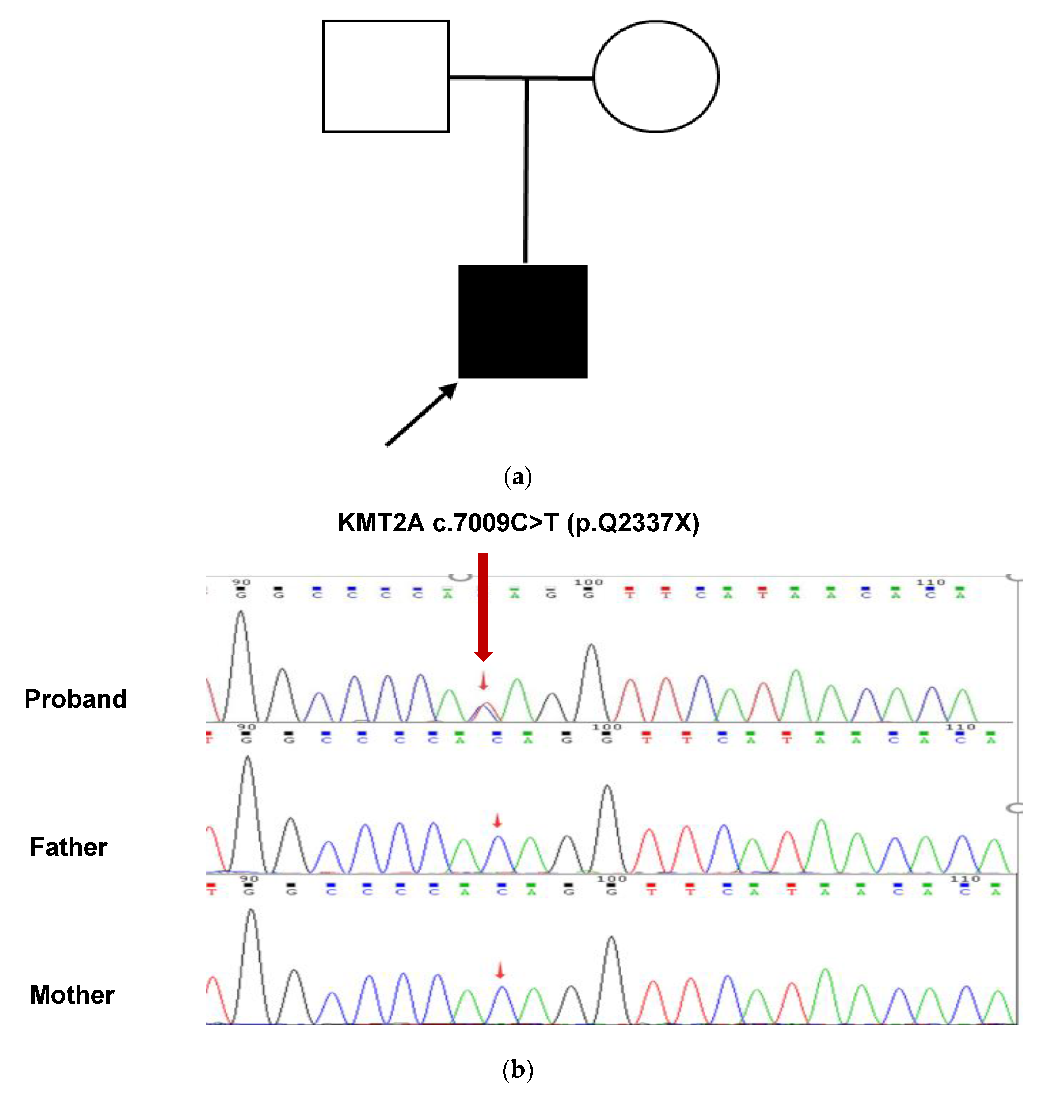 Case report: a Chinese girl like atypical Rubinstein–Taybi syndrome caused  by a novel heterozygous mutation of the EP300 gene, BMC Medical Genomics