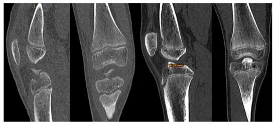 Results of Anterior Cruciate Ligament Avulsion Fracture by Treatment ...