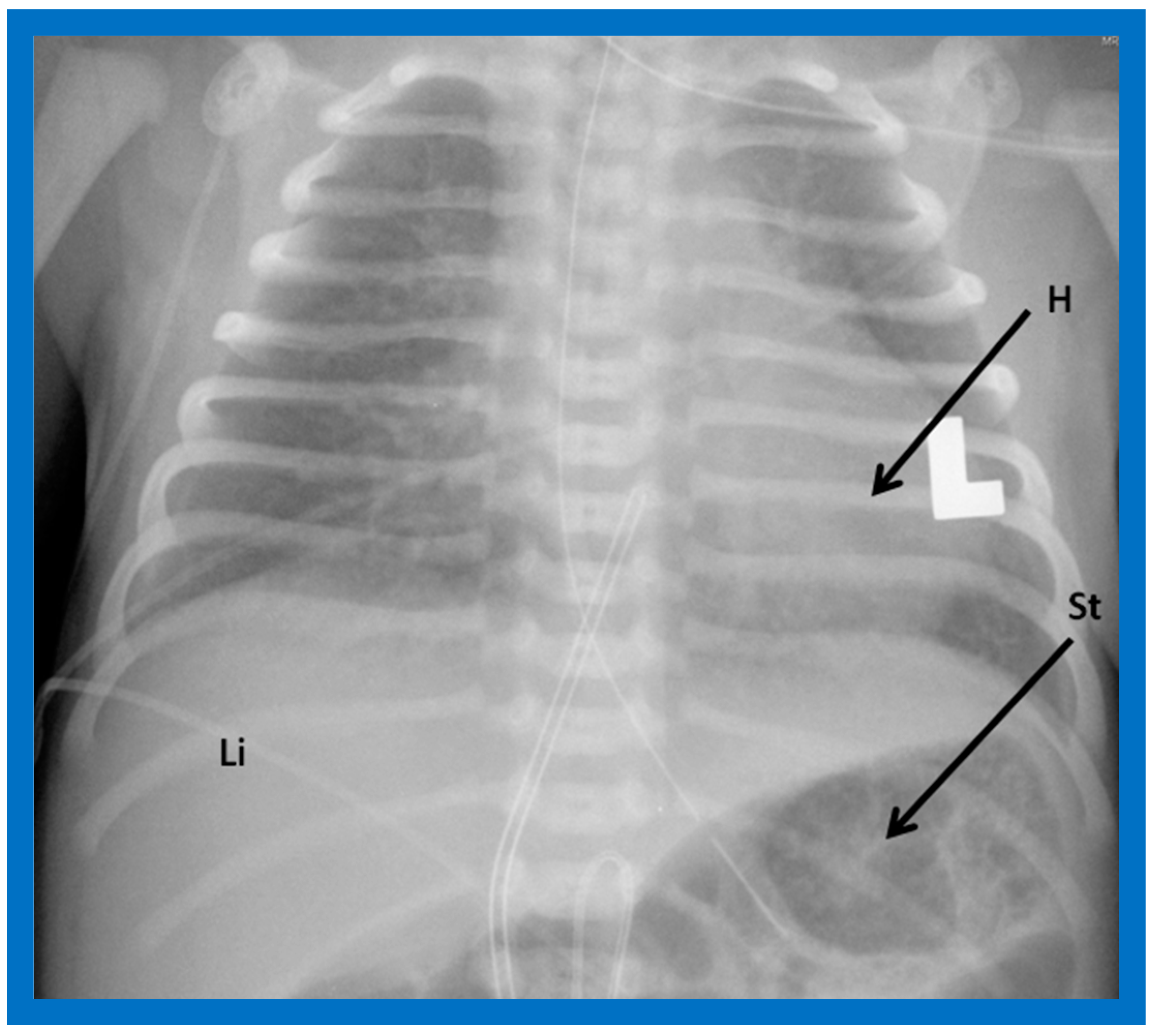 Closed drainage system with a tubular chest tube. A: Tubular chest tube