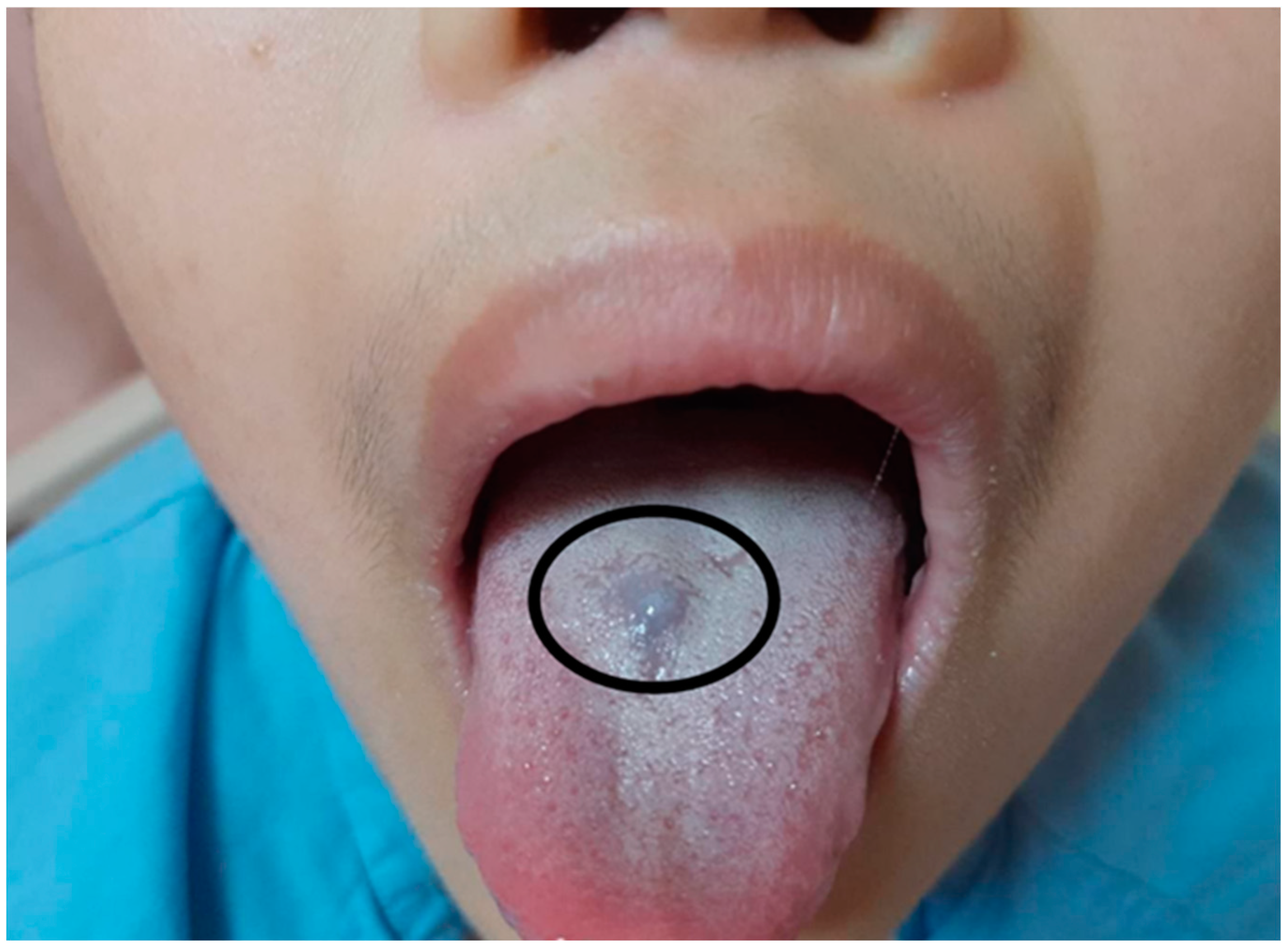 Children | Free Full-Text | Blue Rubber Bleb Nevus Syndrome (BRBNS): A Rare  Cause of Refractory Anemia in Children