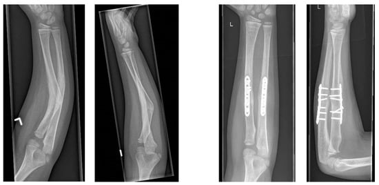 Revista Brasileira de Ortopedia - Treatment of Distal Radio Vicious  Consolidation: Corrective Osteotomy Through 3D Printing  Prototyping<sup>*</sup>