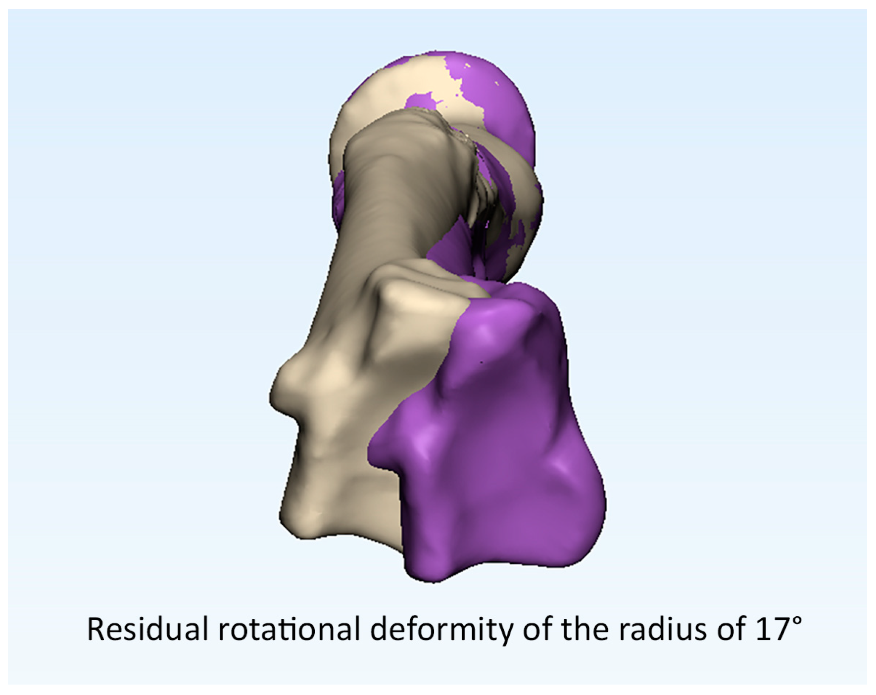Revista Brasileira de Ortopedia - Treatment of Distal Radio Vicious  Consolidation: Corrective Osteotomy Through 3D Printing  Prototyping<sup>*</sup>