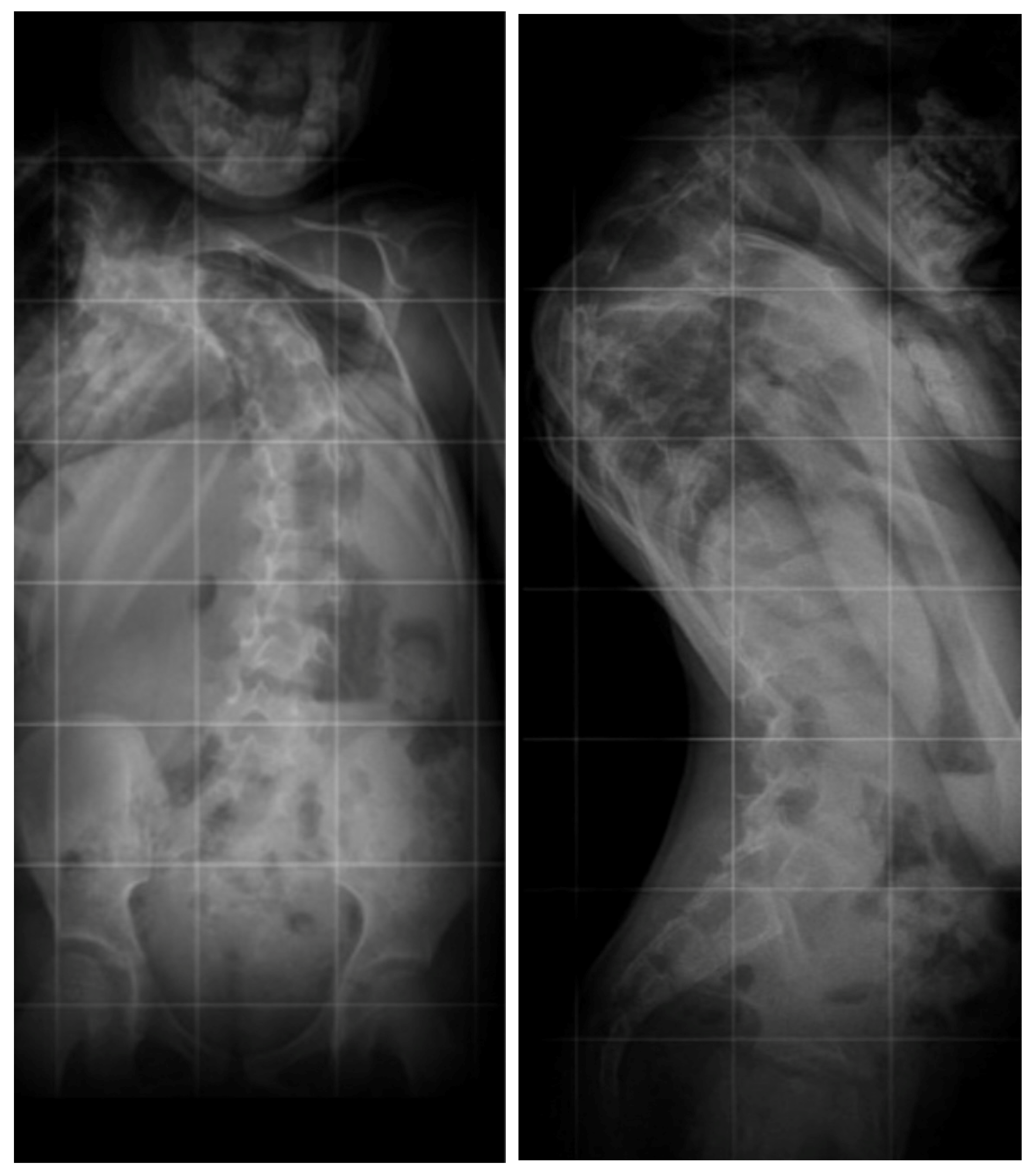 Thoracic Outlet Syndrome: Review of Surgical Approaches and Radiographic  Complications • APPLIED RADIOLOGY