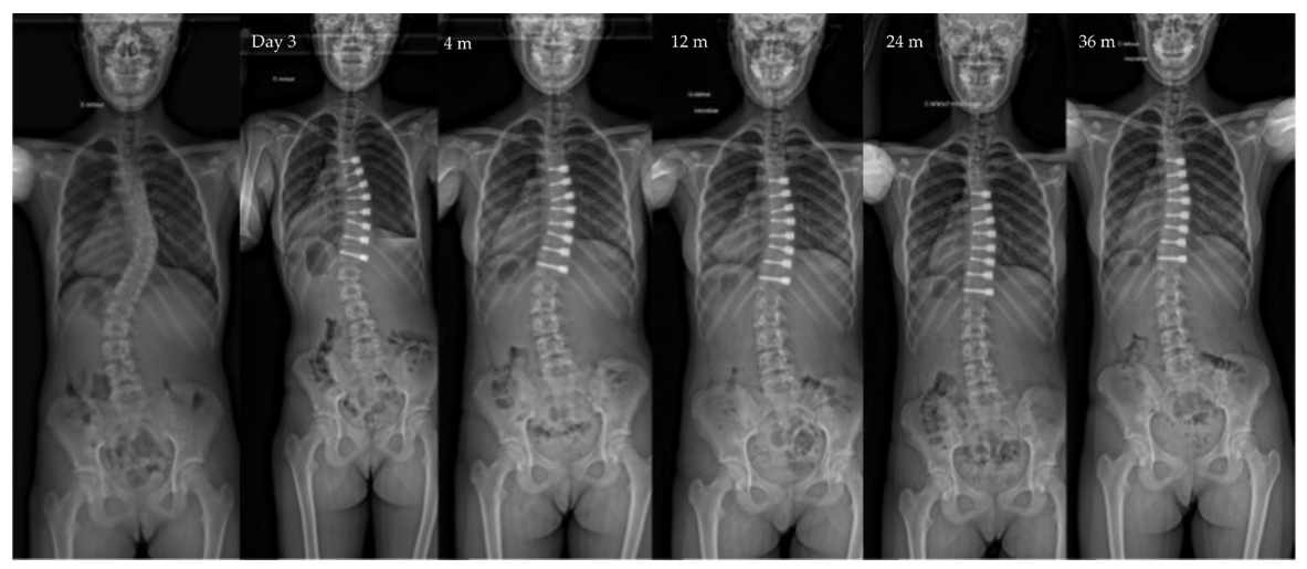 Children | Free Full-Text | Vertebral Body Tethering in AIS  Management&mdash;A Preliminary Report