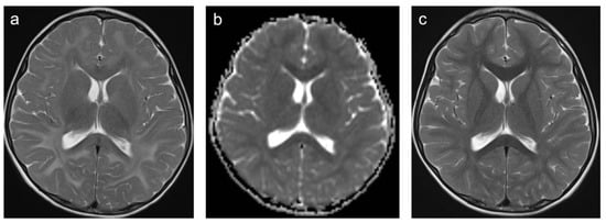 Children | Free Full-Text | Characterization Of MRI White Matter Signal ...