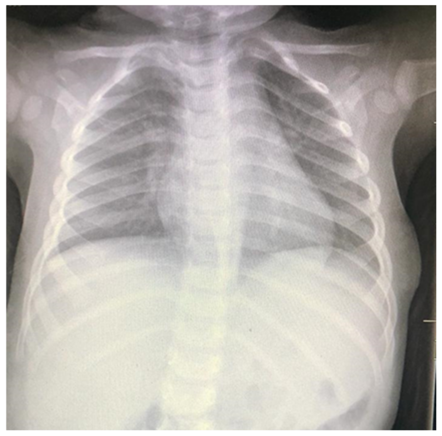 a) A 12-year-old boy presented with a large chest wall mass, later