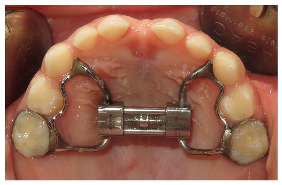 The Role of the Palatal Expander in Pediatric Orthodontistry