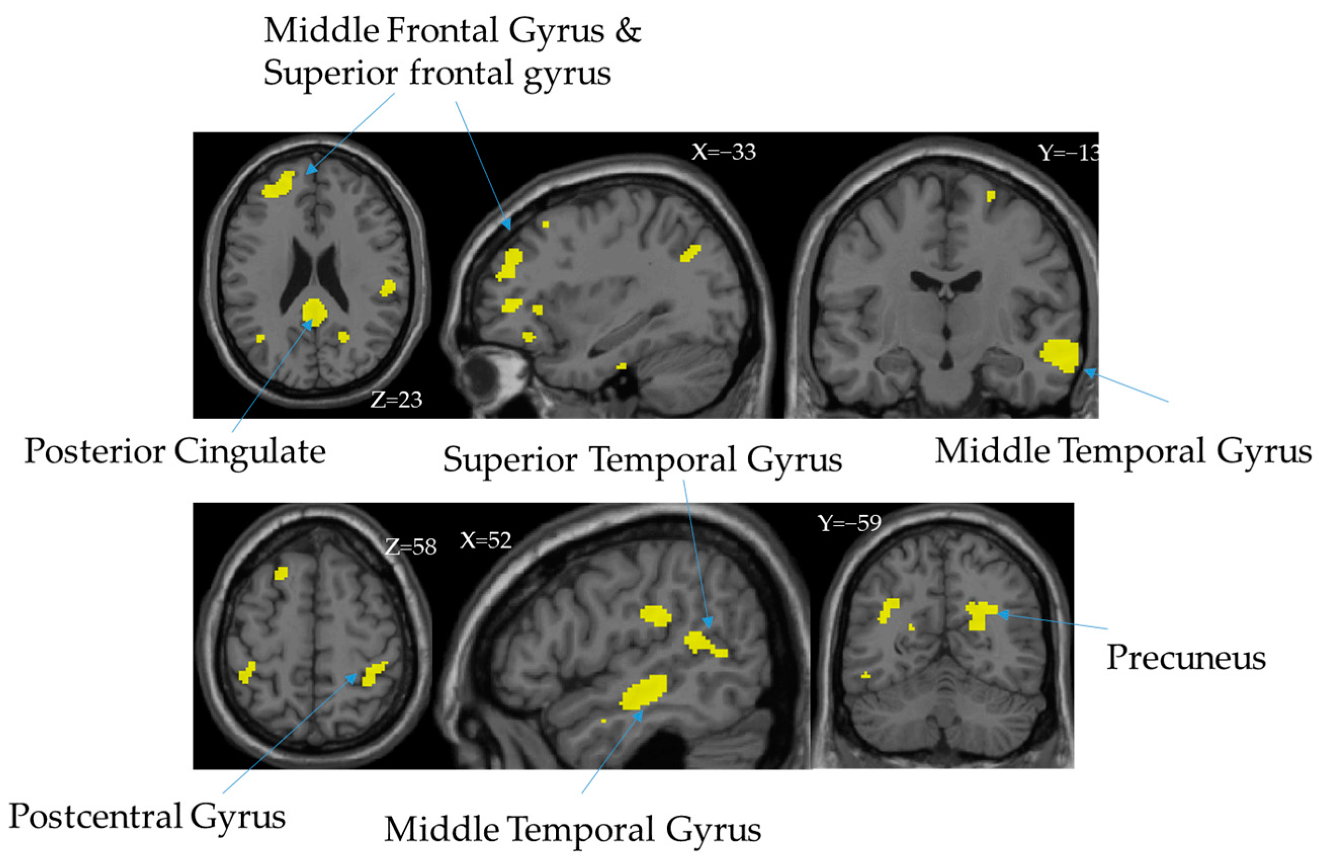 superior frontal gyrus mri