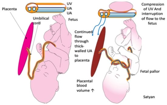 Compression garment. Fig. 2 Breast at 1 week of postpartum with