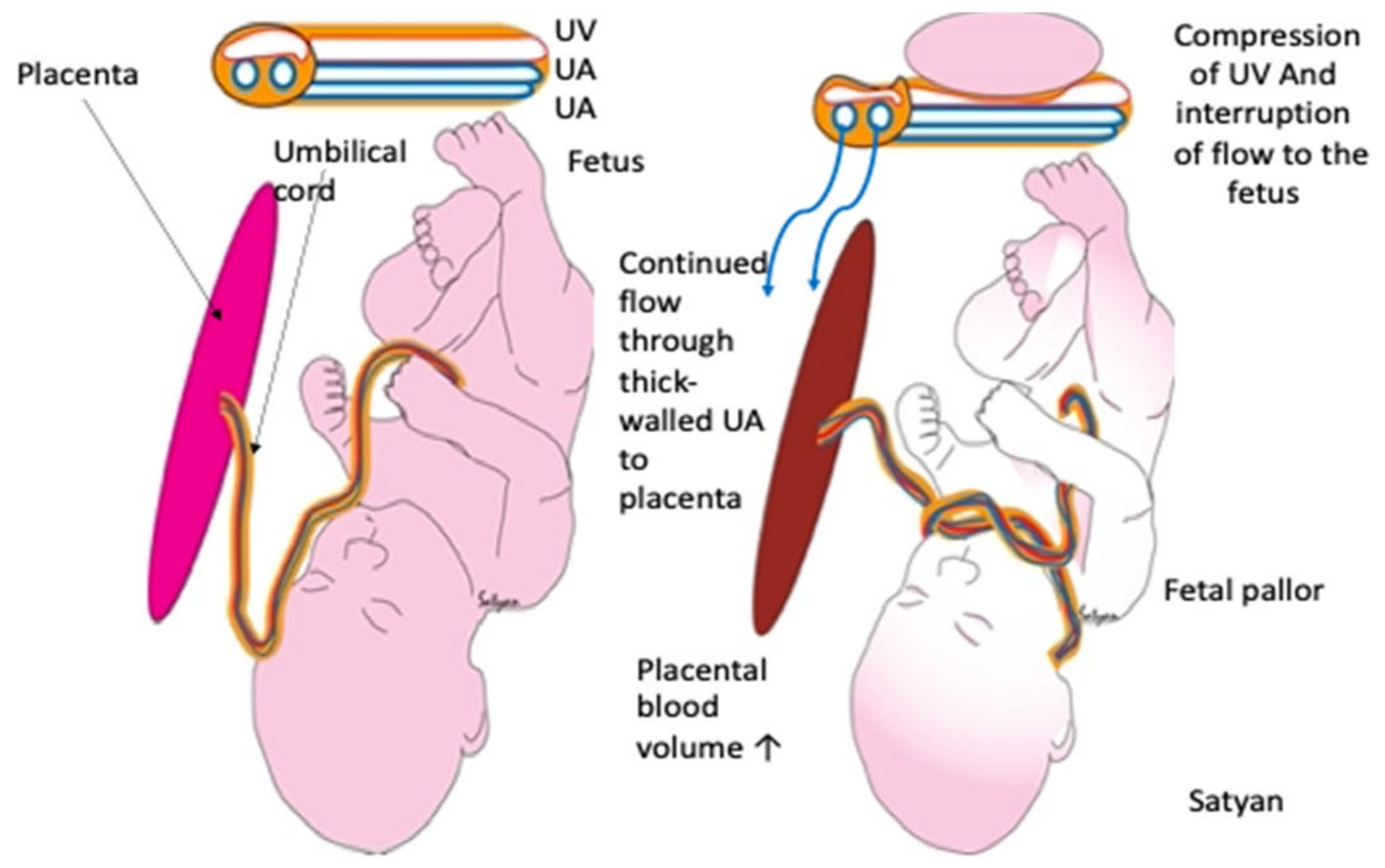What Are the Signs of Umbilical Cord Compression?