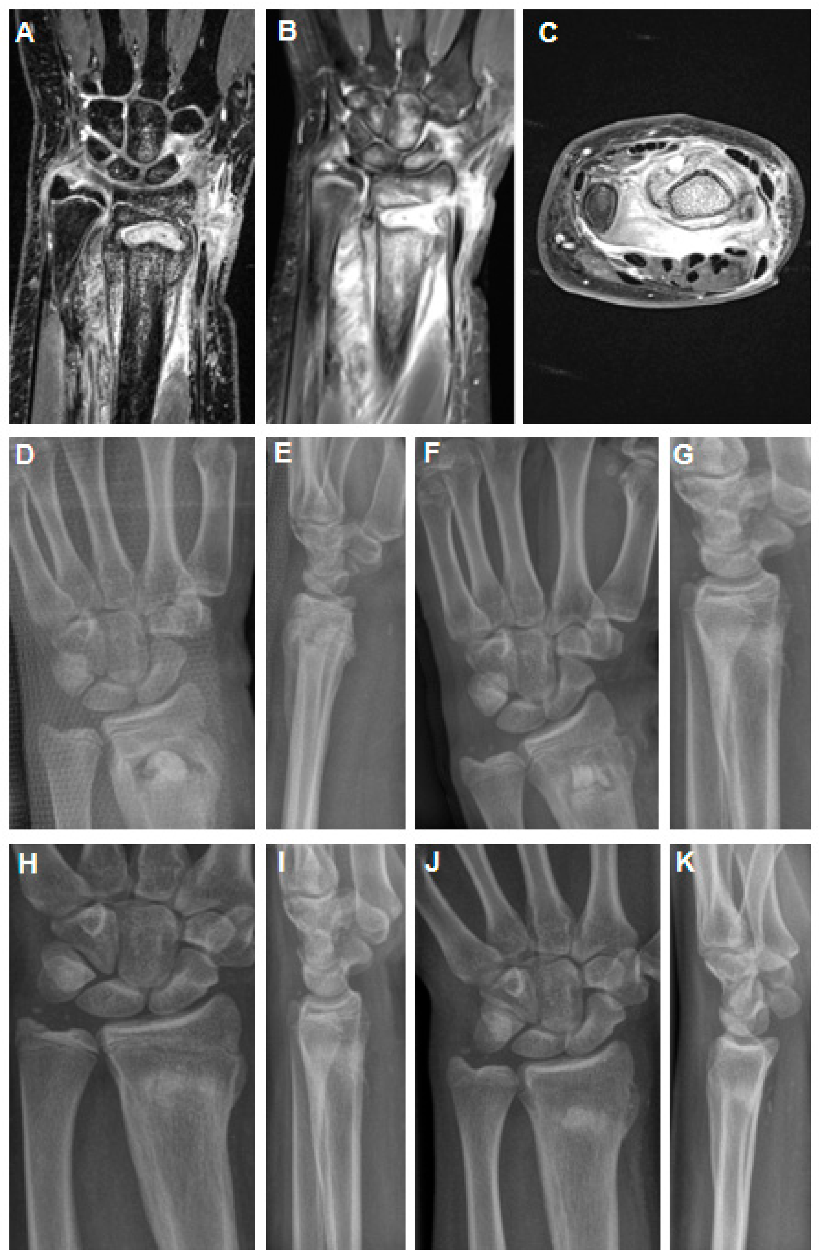 Children | Free Full-Text | Treatment of Fracture-Related Infections with  Bone Abscess Formation after K-Wire Fixation of Pediatric Distal Radius  Fractures in Adolescents&mdash;A Report of Two Clinical Cases