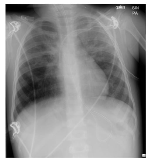 Children | Free Full-Text | Severe COVID-19 Pneumonia in a Three-Year ...