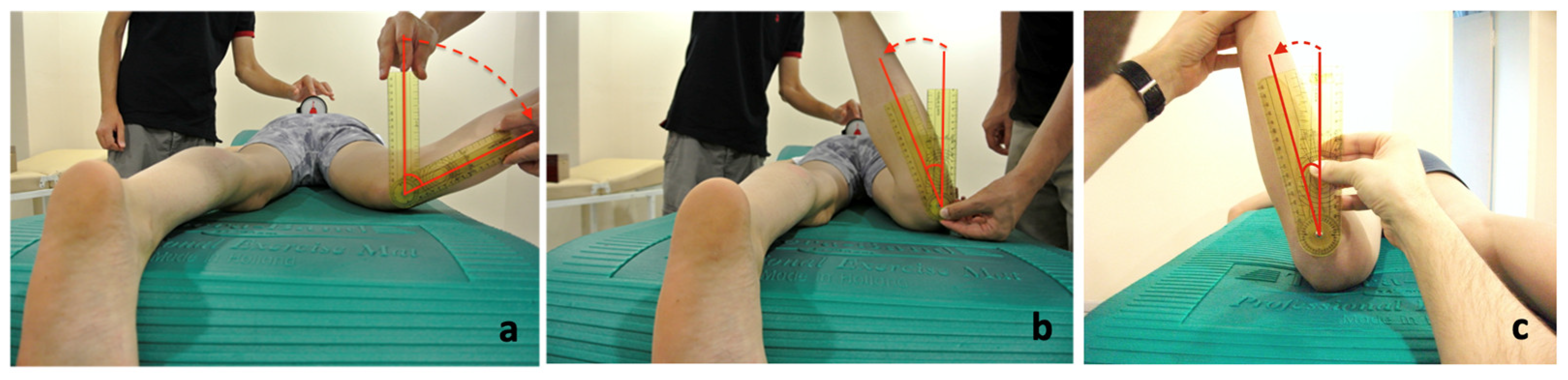 A) Femoral anteversion is the angle of rotation along the length