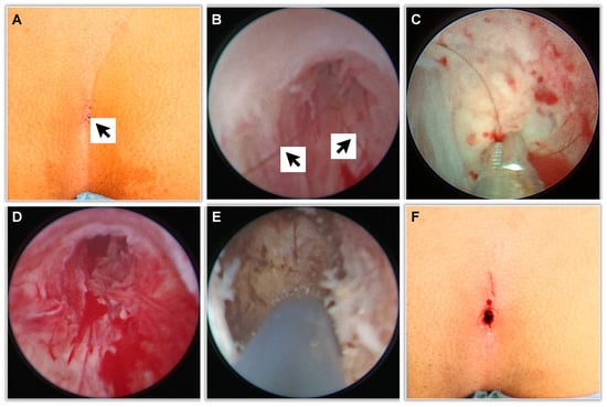 Updates on the Management of Pilonidal Disease - Advances in Pediatrics