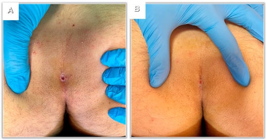 Pilonidal cyst - Symptoms and causes - Mayo Clinic