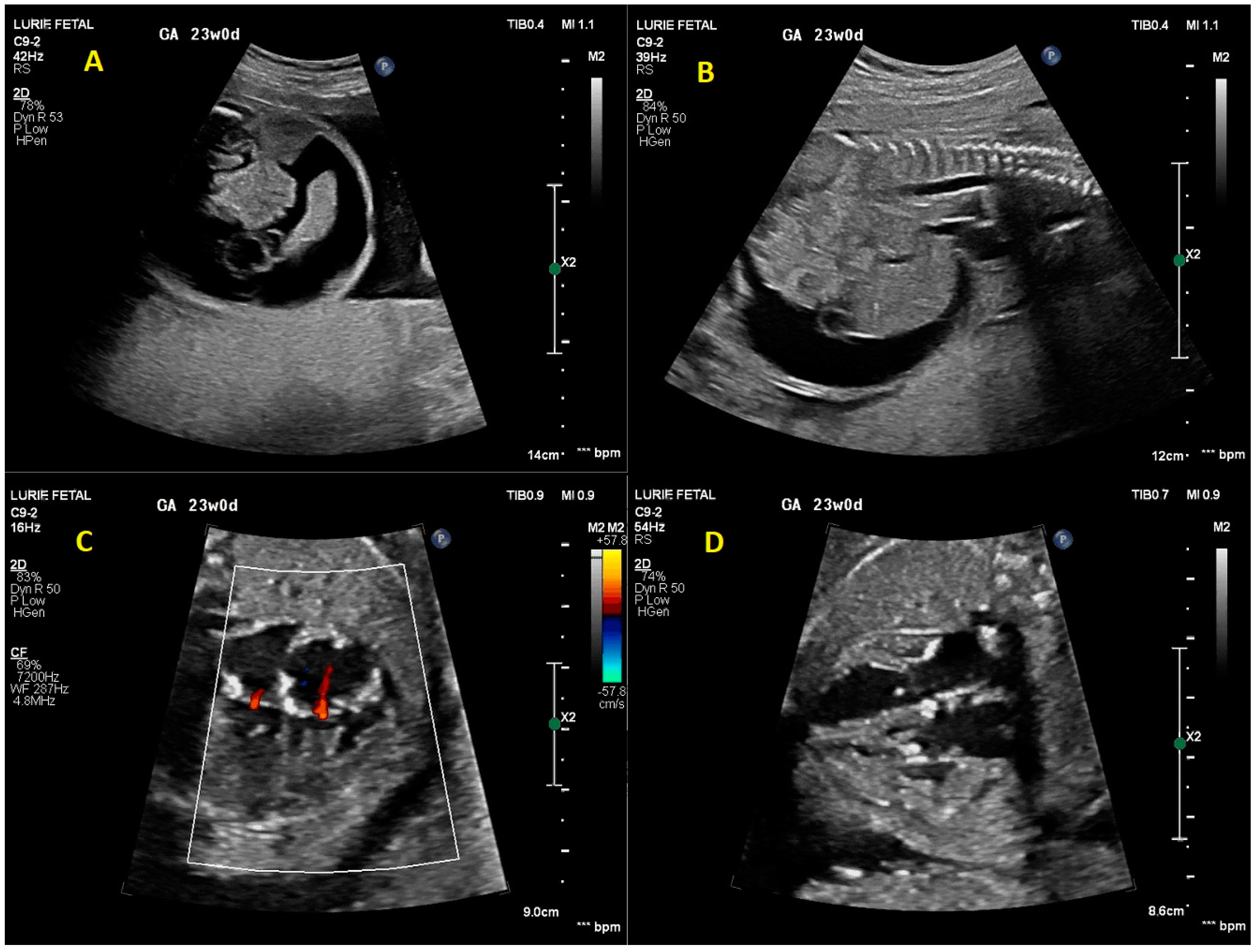 Second-degree atrioventricular block (fetal echocardiography