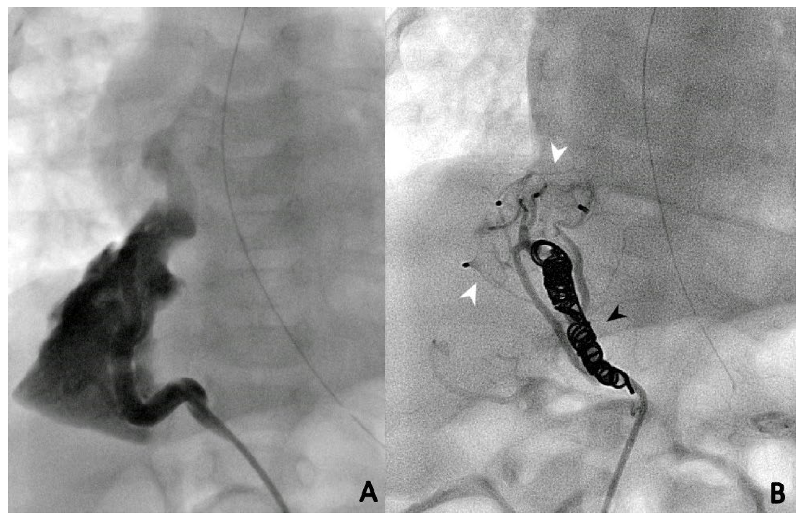 Children | Free Full-Text | Transcatheter Management of Pulmonary ...