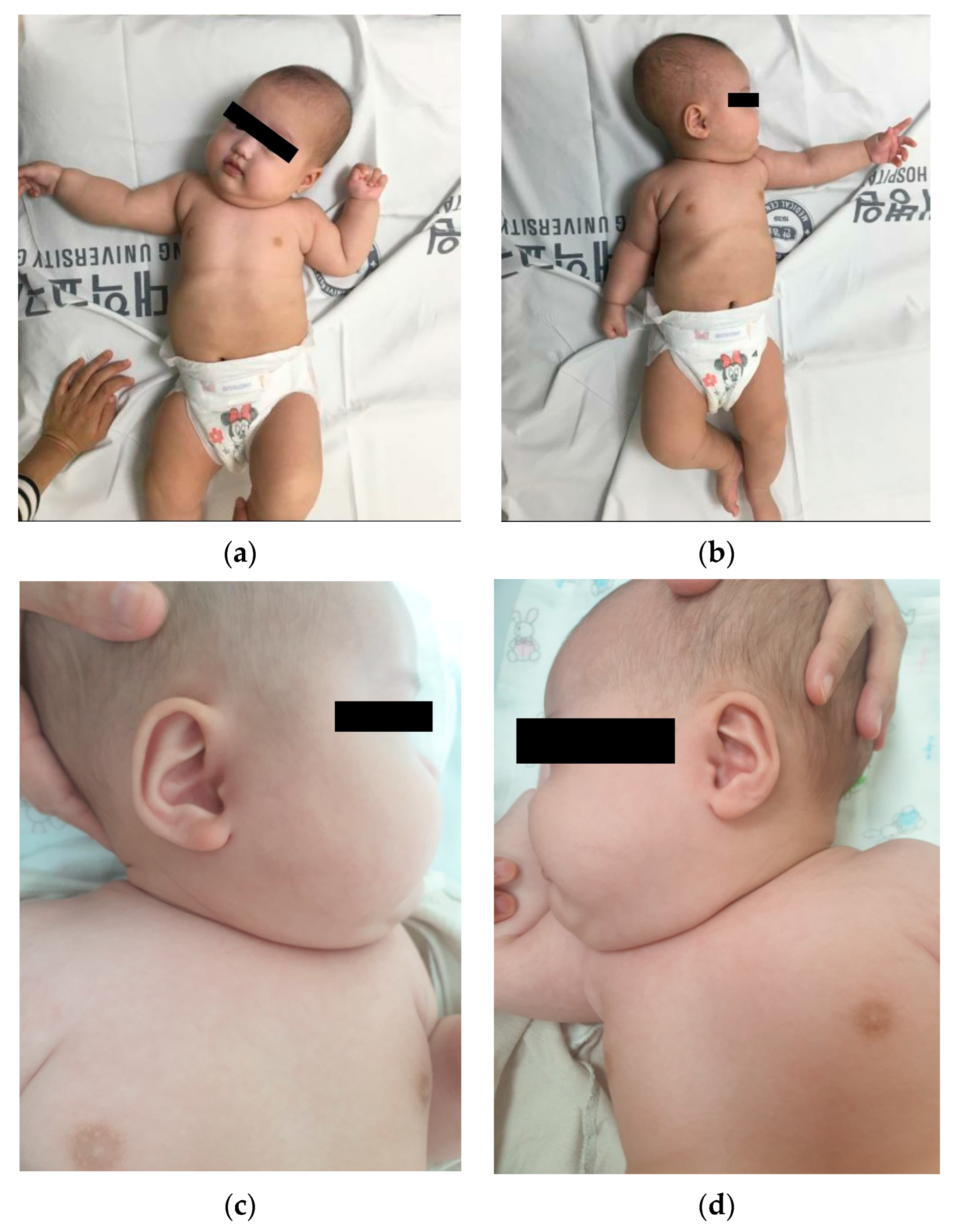 Children | Free Full-Text | Congenital Hemihyperplasia in an Infant with  Ipsilateral Torticollis: A Case Report