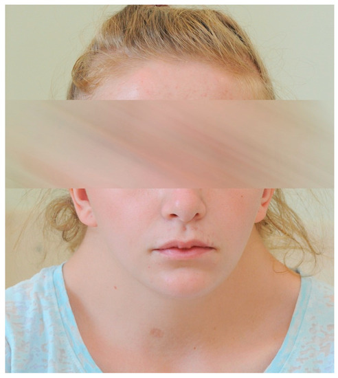 Children | Free Full-Text | Anterior Uveitis and Coats Disease in a  16-Year-Old Girl with Noonan Syndrome&mdash;A Case Report