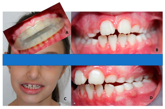 A Guide To Dental Braces: Types and How It Works - CD