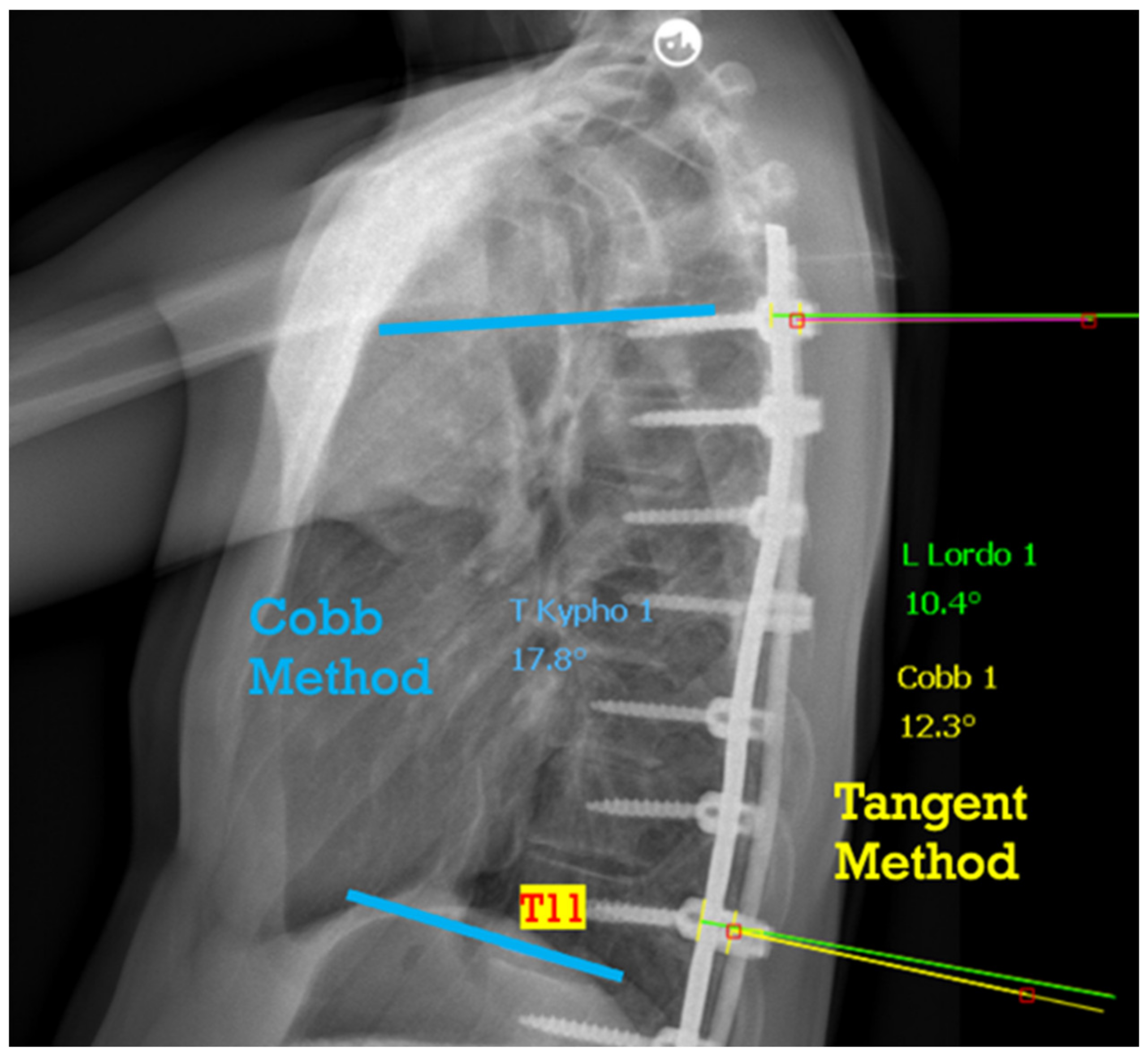 Thoracic spine x-ray Information
