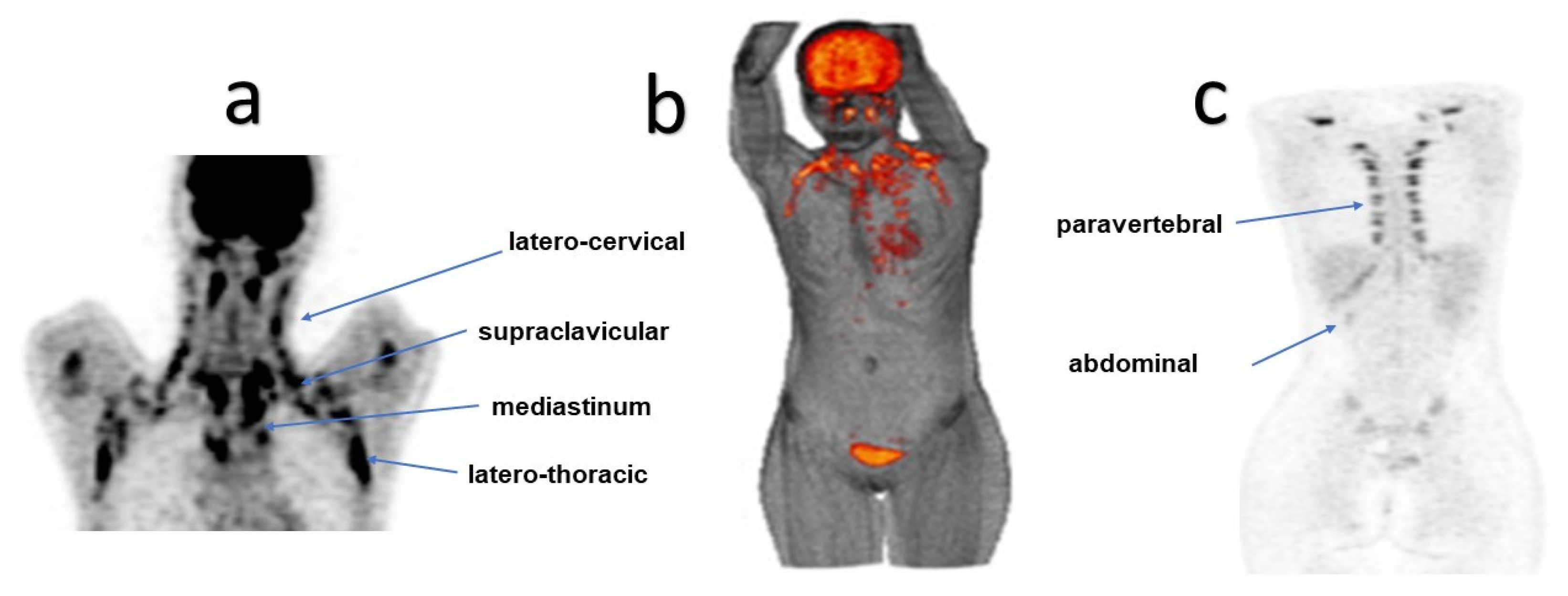 Associations of brown adipose tissue (BAT) 18 F-FDG activity after a