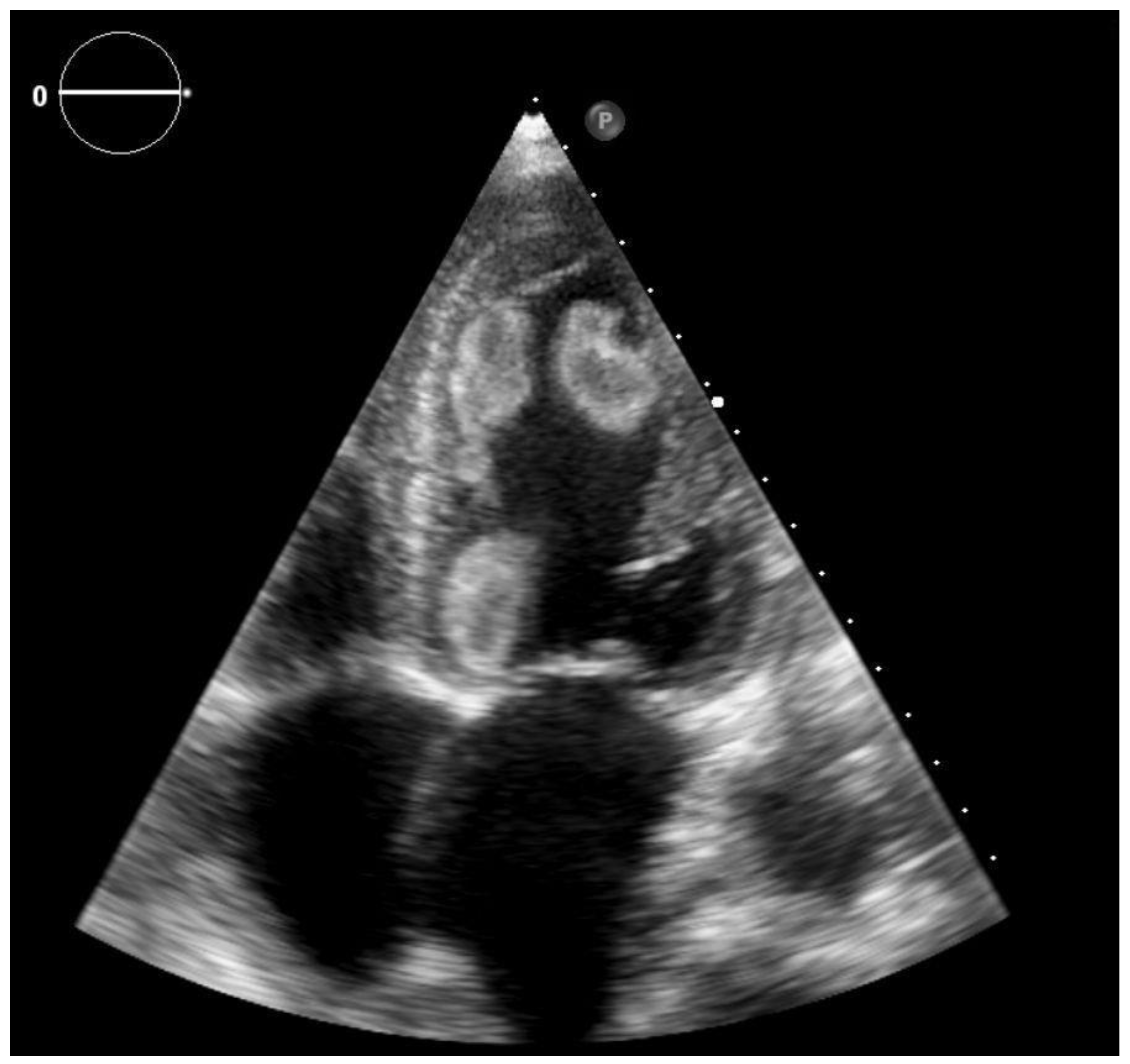 echo teaser global hypokinesia in apical view note the slow contraction of  lv 