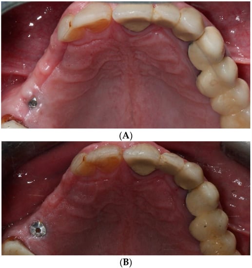 Coatings Free Full-text Marginal Bone Loss In Implants With External Connection Versus Internal Conical Connection Prior To Prosthetic Loading A Randomized Clinical Study Html